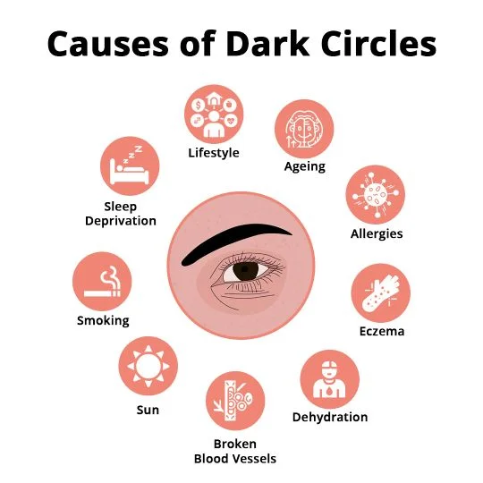 Causes of Dark Circles